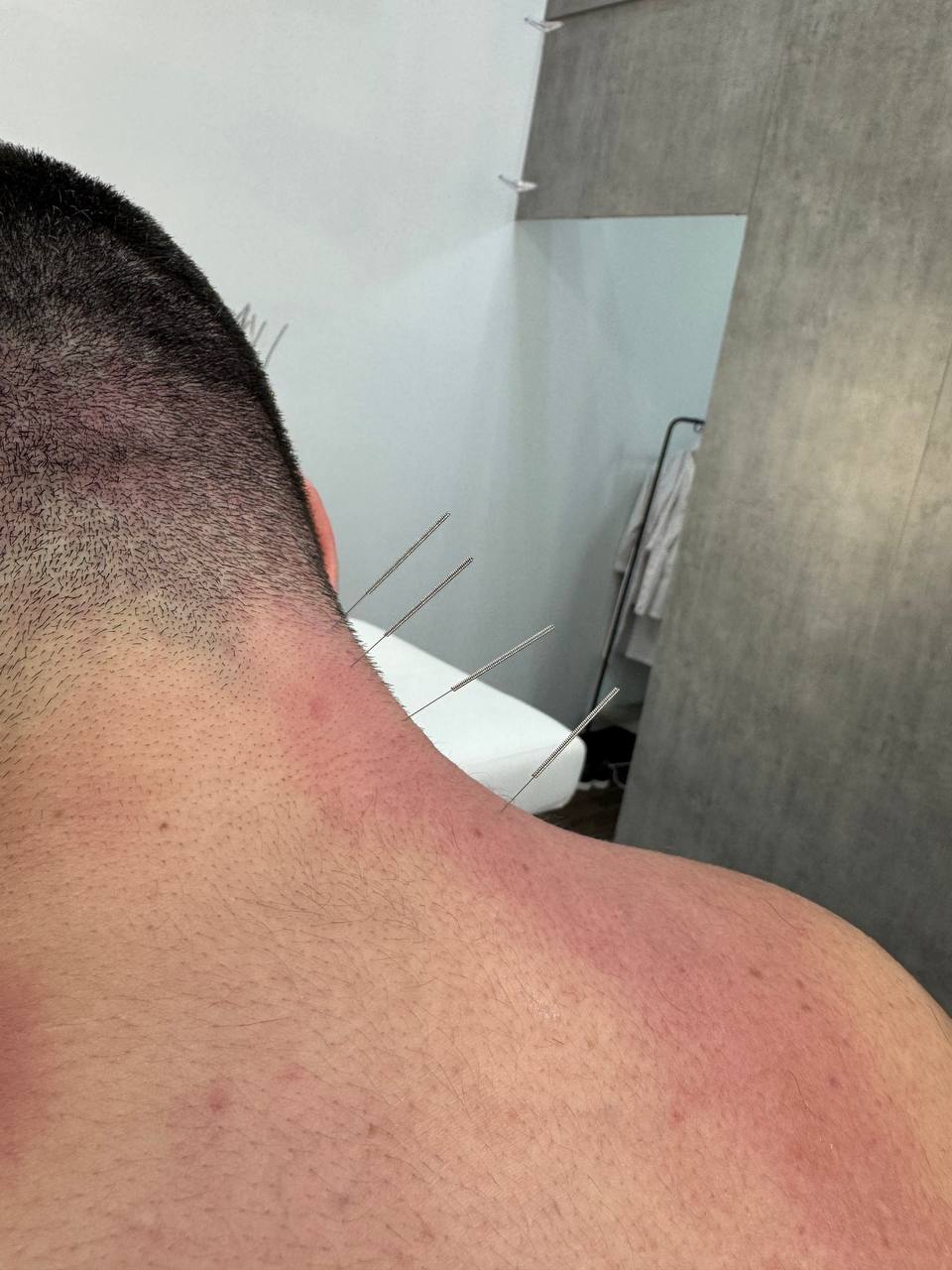 Электро-аккупунктура